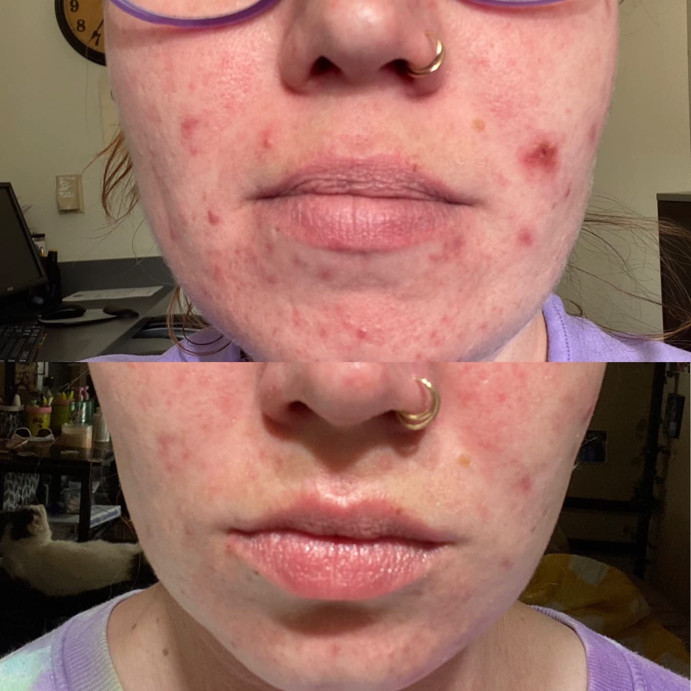 reVive Light Therapy Clinical Acne Device, Red & Blue Light Wand, Full Size customer photo 2