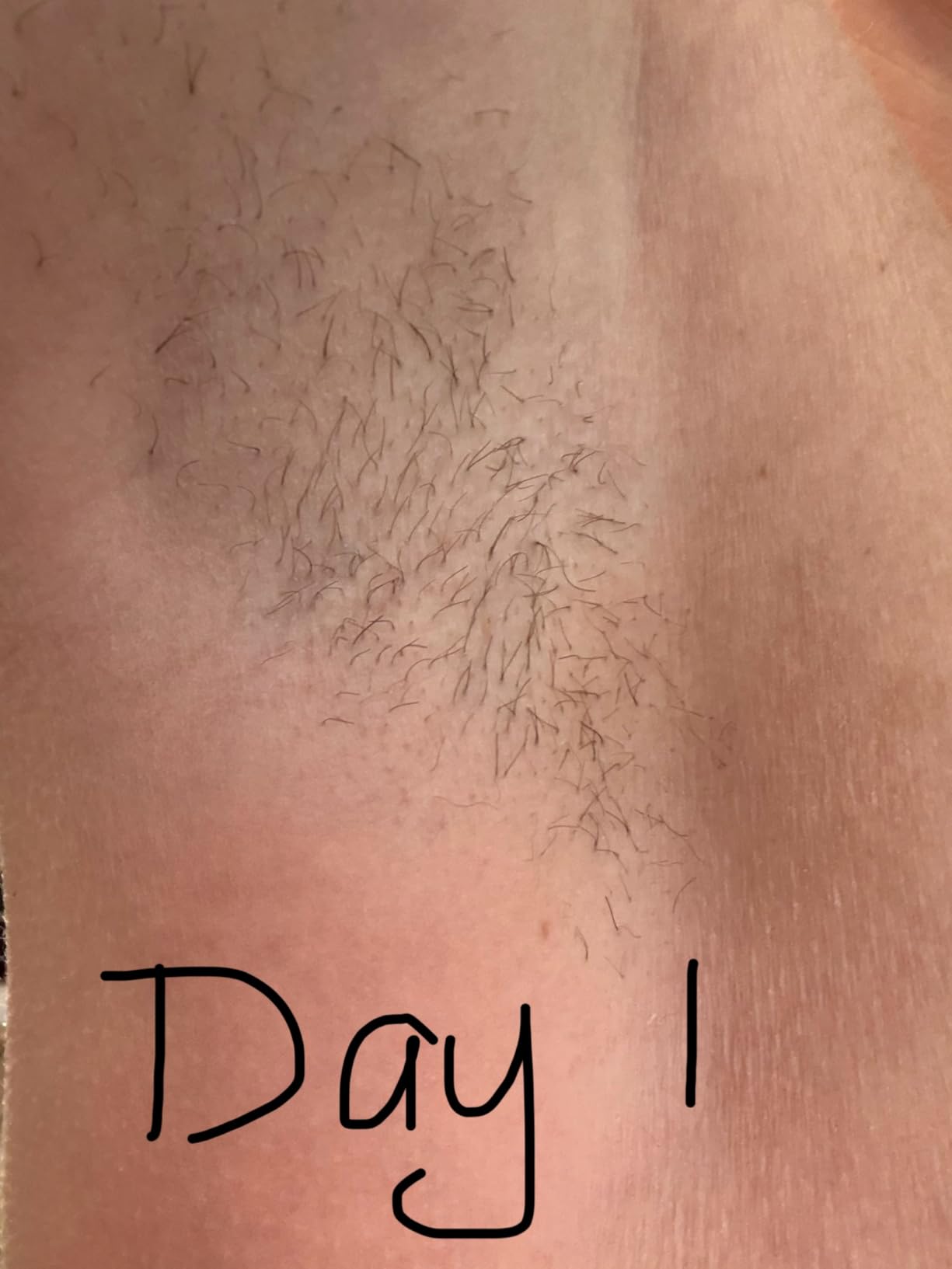 SmoothSkin Pure Adapt IPL Laser Hair Removal Device – At-Home Permanent Hair Reduction, Fast & Effective Results, Patented Smart Skin Tone Sensor, Gray customer photo 1