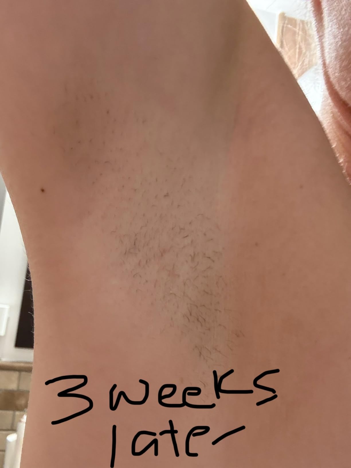 SmoothSkin Pure Adapt IPL Laser Hair Removal Device – At-Home Permanent Hair Reduction, Fast & Effective Results, Patented Smart Skin Tone Sensor, Gray customer photo 2